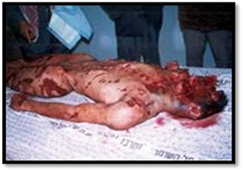 Palestinian Victime of Jew Kidney Grubbing
