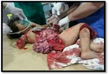 Palestinian child with guts blown out